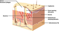 Fixskin - illustration of Fixskin's Toner and Keloid Removal Serum destroying Keloid causing bacteria in the dermis layer of human skin.